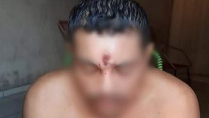 Homem leva tiro na testa e vai para casa dormir; especialista explica como isso é possível